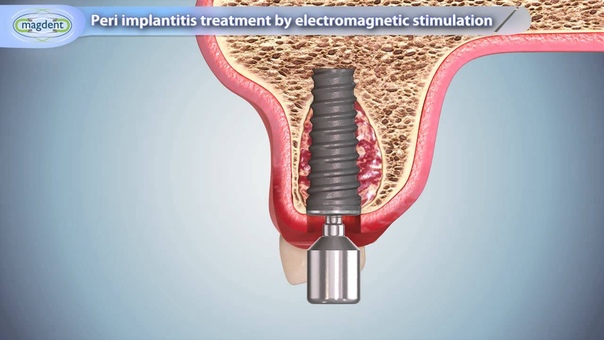 Peri Implantitis Treatment by Electromagnetic